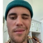 Ramsay Hunt Syndrome Makes a Alarming Affect on Justin Bieber